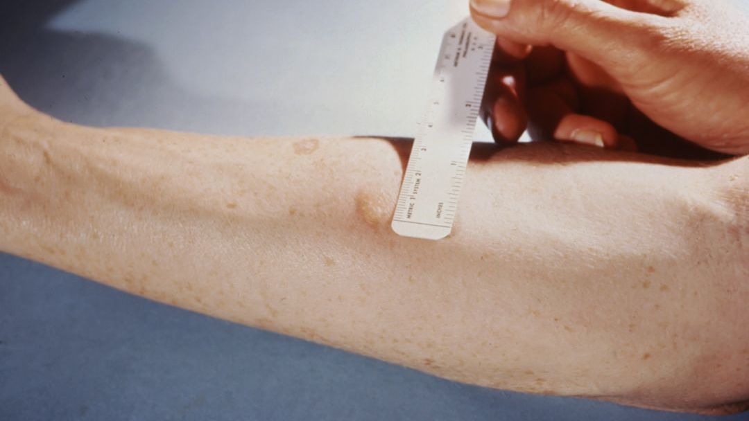 Diagnostic dilemma: Biopsy triggered 'spontaneous regression' of woman's arm tumor